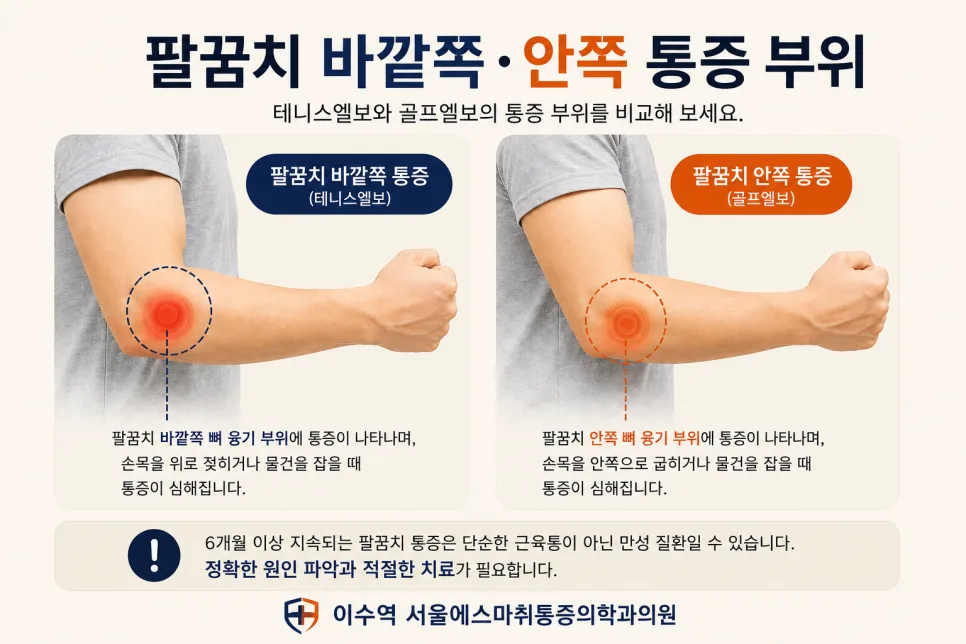 이수역 팔꿈치 통증이 6개월 넘게 이어질 때 확인할 것 관련 사진 2