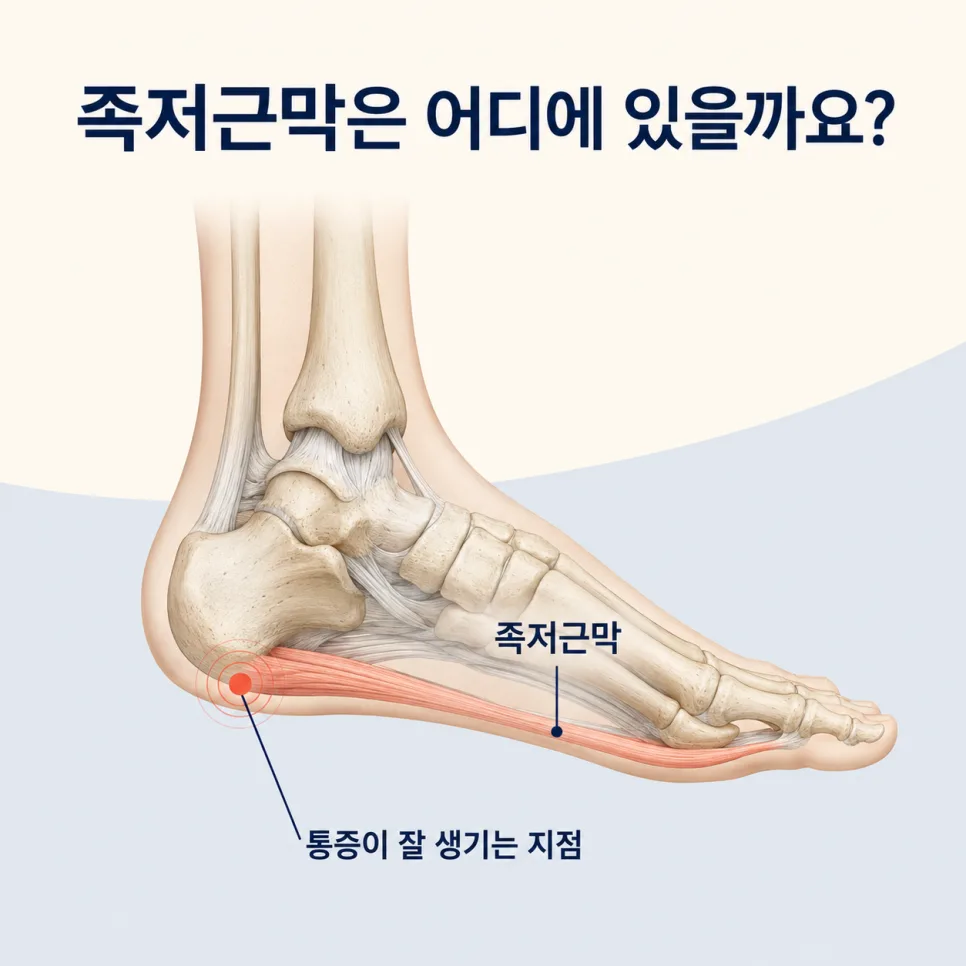 이수역 족저근막염, 아침 첫걸음이 아픈 이유와 치료 순서 관련 사진 3